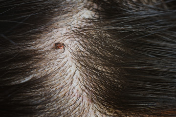 tick on long hair head skin. Risk of Lyme disease