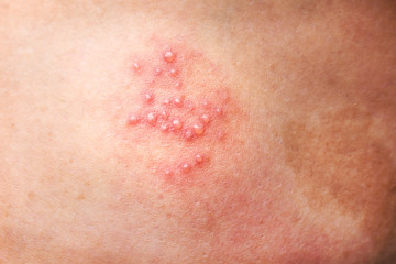 Fototapeta premium Woman leg skin background have red rash from herpes zoster or shingles disease