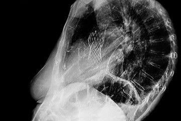 Chest lateral X- Ray which shows an aortic valve replacement done through a femoral artery - obrazy, fototapety, plakaty