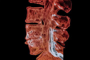 MRI  Spine image lateral view