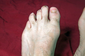 Front of man's foot with damaged to nails - 268524848
