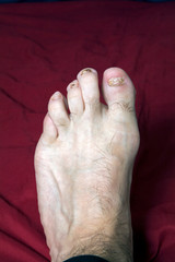 Man's left  foot with damaged nails from wearing tight shoes - 268524873