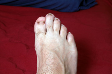 Front of man's foot with damaged nails from wearing tight shoes - 268525013
