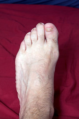mMan's left  foot with damaged nails from wearing tight shoes - 268525023