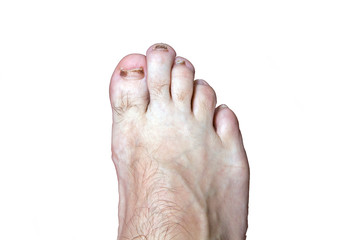Front of man's foot with damaged nails from wearing tight shoes