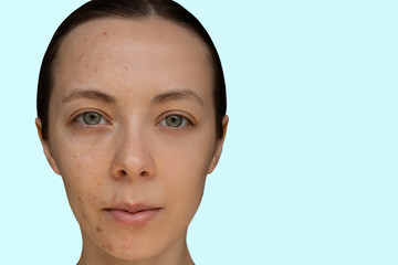 Face of a young girl after a cosmetic procedure of chemical peeling close-up. The concept before...