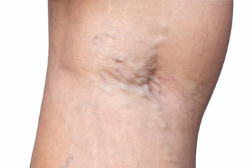 Varicose vein on woman's leg isolated on white background.Vascular disease concept. Clipping path.