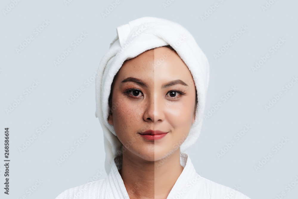 Wall mural comparison portrait of beautiful asian woman. dark spots and new skin, before - after skin care and 