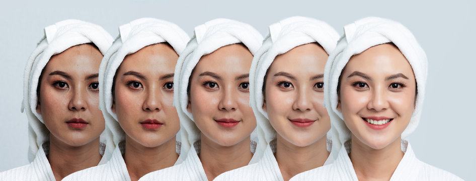 Comparison Portrait Of Beautiful Asian Woman. Dark Spots And New Skin, Before - After Skin Care And Clean Concept, Beauty Treatment Process Of Aging For Rejuvenation.