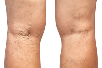 Varicose vein on woman's leg isolated on white background.Vascular disease concept. Clipping path.