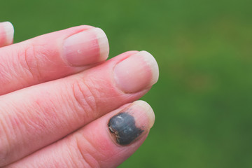 Subungual Hematoma, also known as a bruised finger. This is actually a photograph of my own hand after I dropped a very large stone on my index finger, while gardening.