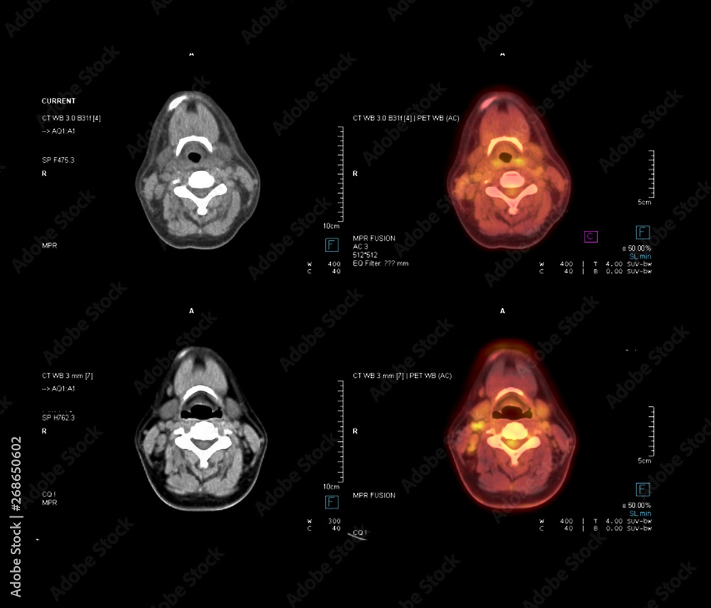 Poster pet ct scan image of neck in axial plane comparison ct scan and pet ct for detect cancer recurrence 