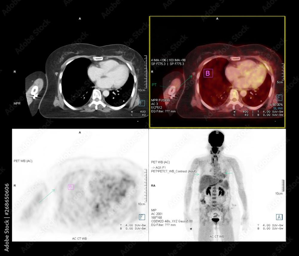 Poster pet ct scan image of whole body comparison axial plane in ct scan and pet ct for detect cancer recur