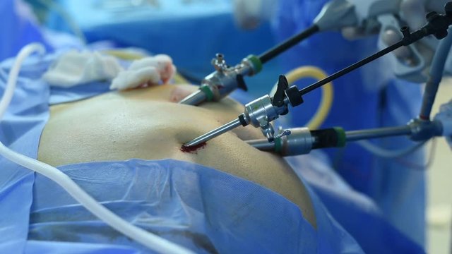 Close-up of surgeon hands performing laparoscopic surgery