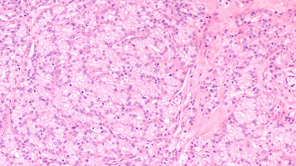 Microscopic image of an acinic cell carcinoma, a rare cancer of salivary glands such as parotid,...