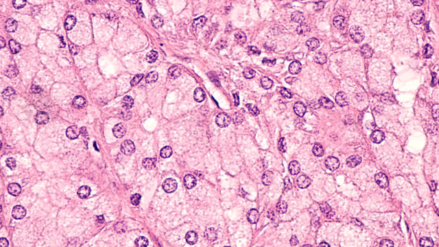 Microscopic image of an acinic cell carcinoma, a rare cancer of salivary glands such as parotid, submandubular or sublingual gland.  They derive from acinar cells and have finely granular cytoplasm.  