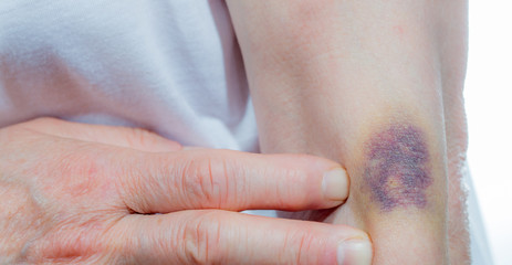 A strong hematoma due to a wrong injection. Concept medical mistakes.