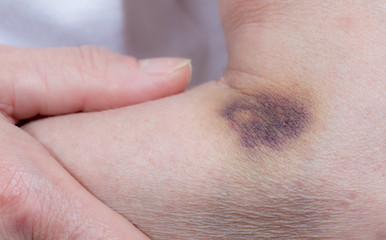 A strong hematoma due to a wrong injection. Concept medical mistakes.