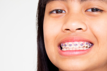 Girl with braces teeth smiling and happy