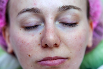 Fototapeta premium Face of a young girl after cosmetological procedures and face cleansing in a pink hat to protect hair. Cosmetology and health.