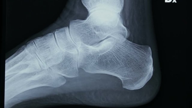 Zoom-in of the radiographic plate of tibia and fibula and of bones of the human foot.