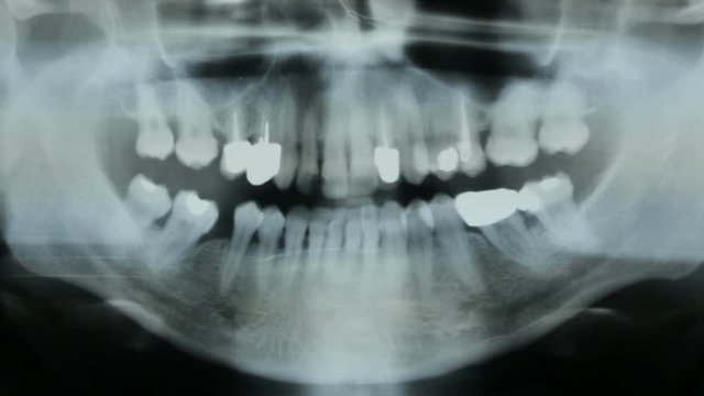 Zoom-in on X-ray plate of the bones of the face and teeth.