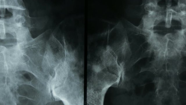 Zoom-in of the X-ray plate of the bones of the spine and the human pelvis, in frontal view.