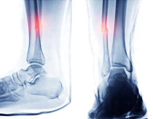 X-ray ankle or Radiographic image or x-ray image of right ankle joint Posterior Ankle Splint AP and Lateral  showing fracture fibula bone.