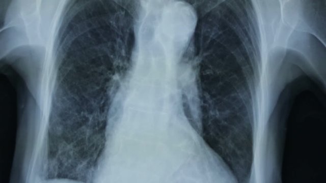 Zoom-in of the X-ray plate of the human thorax.