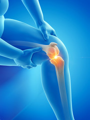 3d rendered medically accurate illustration of an overweight womans painful knee joint