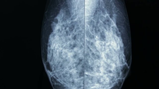 Zoom-in della lastra radiografica mammography, for breast cancer prevention.