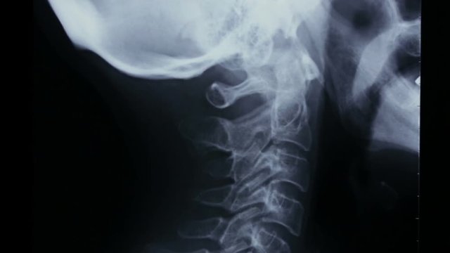 Zoom-in on X-ray plate of the bones of the head and of the human neck, in lateral view.