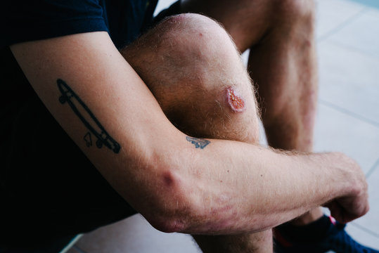 Bloody knee of skater