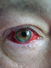 : Red eye following an irritation of the sclera after a grain of sand entered the eye while on a...