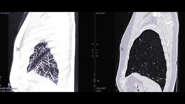 CTA Chest with contrast media comparison Sagittal MIP and sagittal 2D for diagnostic Pulmonary embolism (PE) and lung cancer .