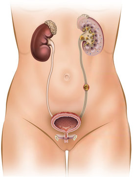 Esquema descriptivo de c&aacute;lculos renales.