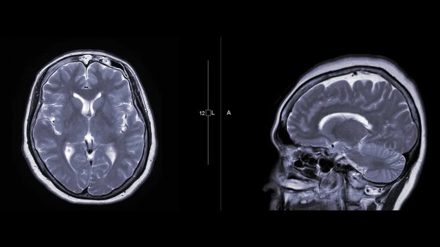 MRI brain or Magnetic resonance imaging ( MRI ) of the brain compare axial and sagittal  plane with gadolinium contrast media.