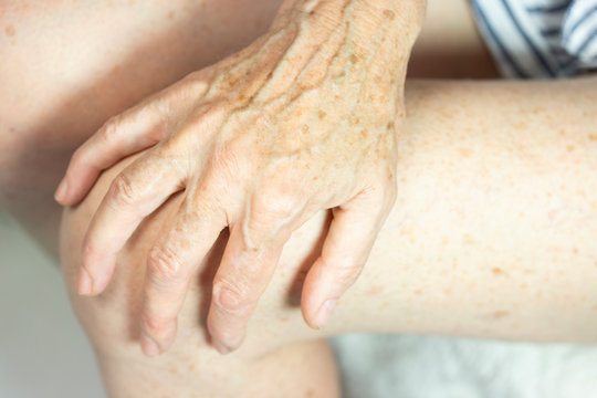 Hand With Spots Of Old Age Stock Photo Adobe Stock