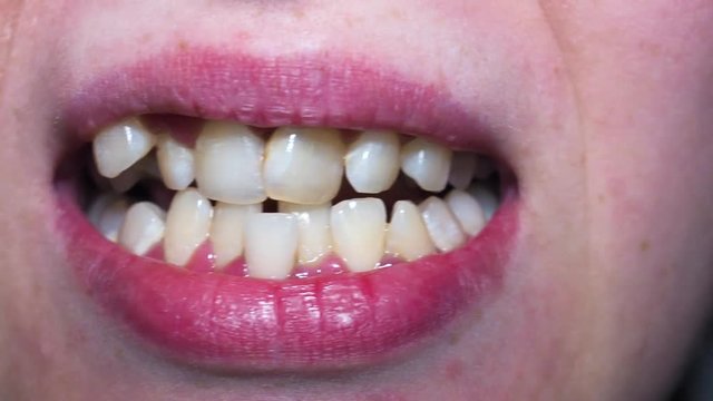Orthodontics braces. Bad teeth needing medical attention