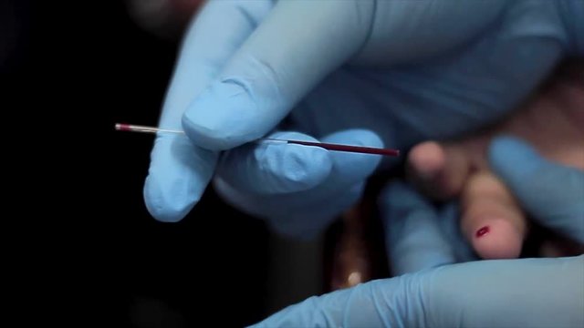 As a part of donor screening blood collection is being done through capillary puncture method and with the use of the microcapillary tube, blood is collected.