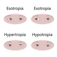 Strabismus types in infants, child, kid. Cross-eyed, esotropia, inward eyes, wall-eyed, exotropia, outward, hypotropia, downward, hypertropia, upward eyes. Vector flat medical illustration.