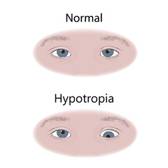 Strabismus in infants, child, kid. Hypotropia, downward eyes. Comparison with normal. Vector flat medical illustration.