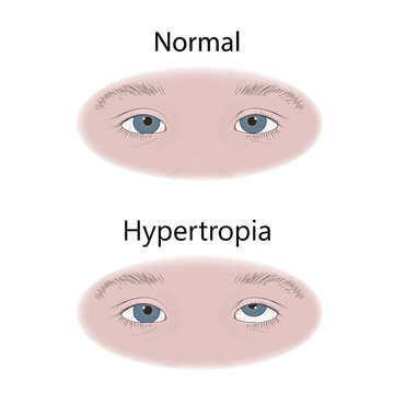 Strabismus in infants, child, kid. Hypertropia, upward eyes. Comparison with normal. Vector flat medical illustration.