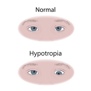 Strabismus in infants, child, kid. Hypotropia, downward eyes. Comparison with normal. Vector flat medical illustration.