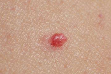 Cherry Angiomas on male skin - super macro close up