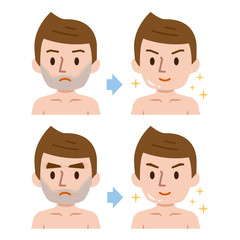 ヒゲ脱毛　男性　ビフォーアフター
