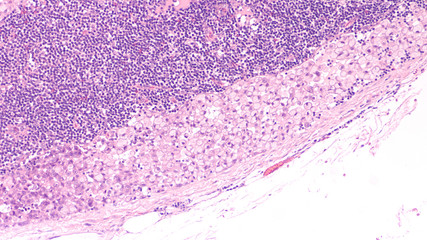 Fototapeta premium Microscopic image (photomicrograph) of a poorly differentiated gastric mucinous adenocarcinoma (stomach cancer), signet ring cell type, metastatic to lymph node.