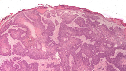 Microscopic image (photomicrograph) of an invasive squamous cell carcinoma of the lip in an elderly...