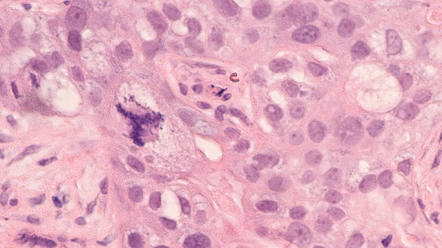 Microscopic image showing a tripolar atypical mitosis in a poorly differentiated breast cancer (infiltrating ductal carcinoma).