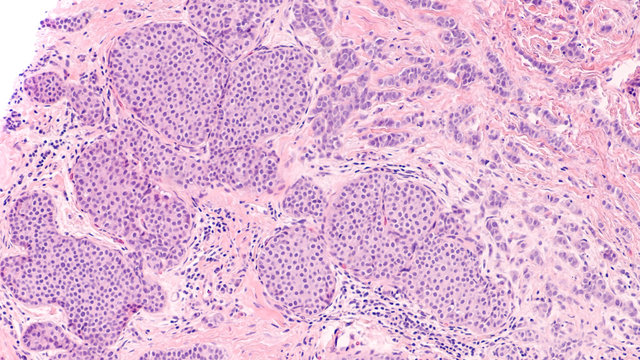 Breast Cancer Histology: Lobular Carcinoma In Situ (LCIS) Is Seen In The Lower Left With Invasive (infiltrating) Lobular Carcinoma In The Upper Right.  Screening Mammography Can Detect Early Tumors. 